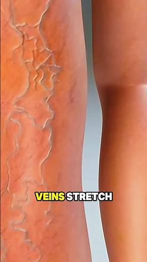 How varicose veins are formed-3D Animation