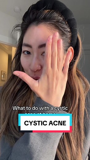 Cystic Acne Care: Essential Tips and Treatments