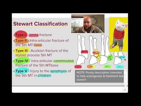 Stewart Classification of 5th Metatarsal Base Fractures (Jones Fracture)