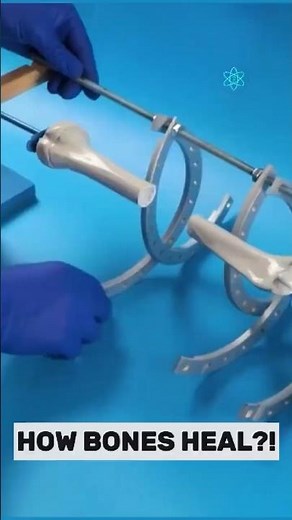 How Broken Bones Are Fixed with External #didyouknow#shortsFrames#medical#surgery#science#education