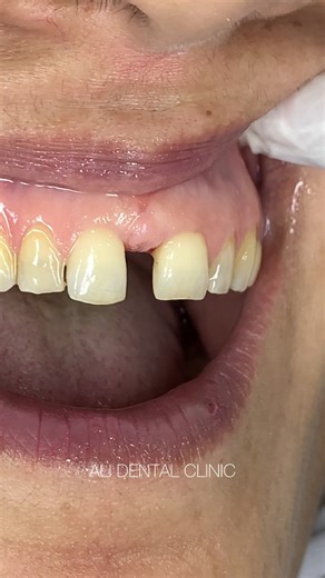 Midline Diastema Closure