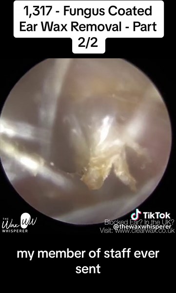 1,317 - Fungus Coated Ear Wax Removal #ear #earwax #earwaxremoval #earwaxcleaning #earwaximpaction #audiologist #thewaxwhisperer DISCLAIMER The information contained in the multimedia content (“Video Content”) posted has been made available for informational and educational purposes only. It does not make any representation or warranties with respect to the accuracy, applicability, fitness, or completeness of the Video Content. It does not warrant the performance, effectiveness or applicability 