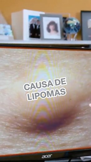 ¿Te han aparecido lipomas en el cuerpo y no sabes por qué? Identifica una de las causas principales que puede estar oculta en tu alimentación. #lipomas #alimentosagresores #cuerpohumano #franksuarez | Frank Suárez