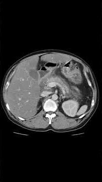 膵炎の原因疾患を探そう #膵炎 #CT #画像診断