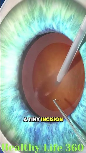 How Cataract Surgery Works (3D Animation) 👀✨ #eye #surgerytips