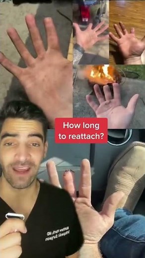 Finger Amputation and Replantation