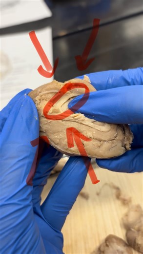 Neuroscience Society on Instagram: "We found a major memory highway 🛣️ during our sheep brain 🐑 🧠 dissection‼️ This video covers the fornix, and its involvement in a memory circuit"