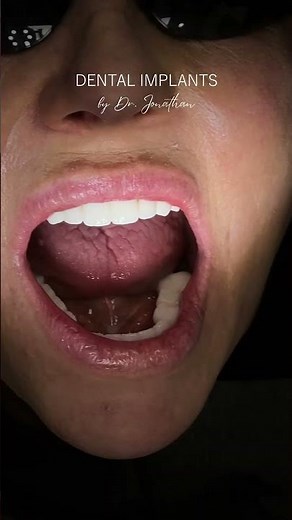 Xcell Dental Implants: Before & After Transformation