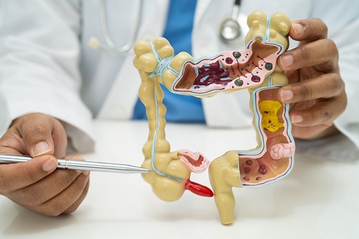 Appendix Cancer on the Rise: Implications for Diagnosis and Patient Care