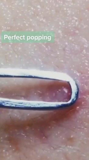 #greenscreenvideo #yoyomcn #pimplepopping #pimpleremover #extractions #zitpopper #acnevideos perfect popping