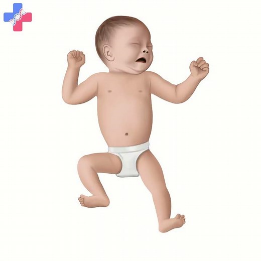 Time Lapse: Caudal Regression Syndrome