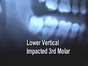 Extraction Of An Impacted Wisdom Tooth