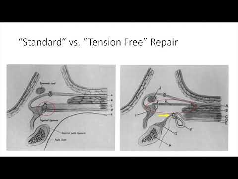 Literature Review: The tension-free hernioplasty (Lichtenstein repair)