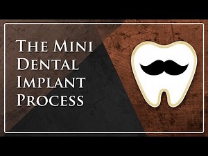 The Mini Dental Implant Process | Atkins Dental Clinic | Dr. Aaron Bratton