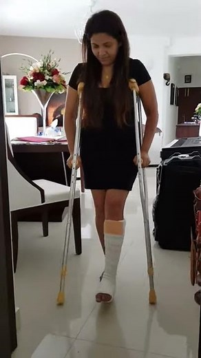 Broken Ankle Modelling , With Crutches , Fracture fibula Leg cast