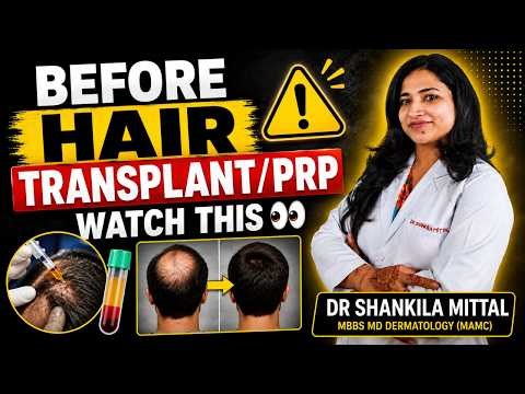 The Biggest PRP & Hair Transplant Mistake for Hair Loss! ⚠️