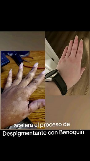 Benoquin: La Crema Despigmentante Permanente para la Piel