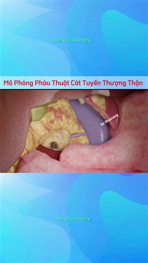 Phẫu Thuật Cắt Bỏ U Tuyến Thượng Thận-Adrenalectomy #kienthuc #ykhoa #yte #phauthuat #tuyenthuongthan