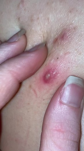 Woah😅 #fyp #foryou #foryoupage #LetsGetBackOnTrack #pimple #whitehead #pimples #pimplepopper #pimplepopping #poppingpimple #pimplepopper2021