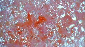 Oozing Morgellons sore