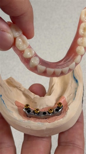 Denture with Locators that we just completed in my laboratory for Dr. James Jones in Virginia