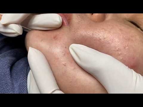 Clearing Up Acne for Middle-Aged Women | Loan Nguyen Acne Treatment Official