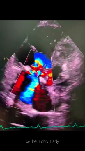 What type of defect can we see here?🫀😯 #echocardiogram #cardiology