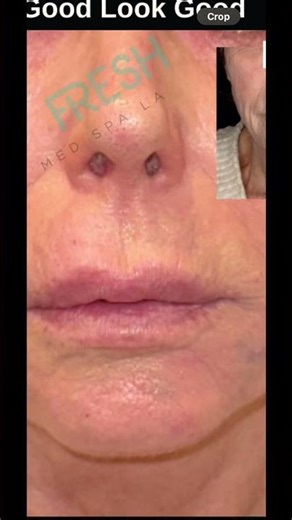 Wrinkles around the mouth also known as smoker’s lines.