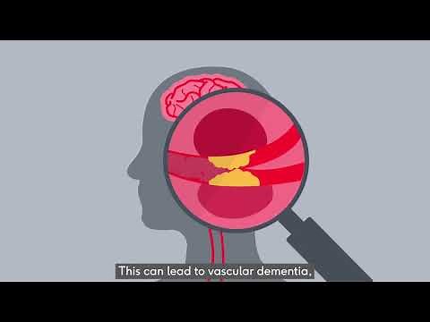 Vascular dementia