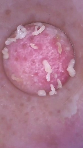 pimple remove on TikTok