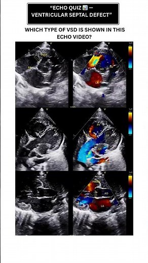 “Echo Quiz 📊 — Ventricular Septal Defect” #echocardiography #cardiologyeducation #2decho