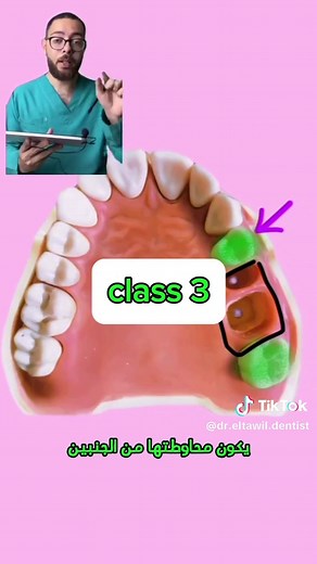 Understanding Kennedy Classifications in Dentistry