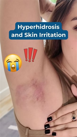 Constant sweating can lead to redness, rashes, and irritation. Managing hyperhidrosis helps protect your skin too.⁠ #Hyperhidrosis #SkinHealth #ExcessiveSweating #Dermadry | Dermadry | Facebook