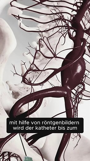 Aneurysma OP erklärt 🧠 So wird eine gefährliche Gefäßausstülpung operativ gesichert, um eine Blutung zu verhindern! #Aneurysma #Neurochirurgie #Gefäßchirurgie #Schlaganfall #Medizinstudium
