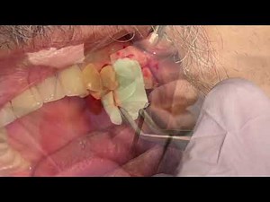 Osteogen Plug Graft, Physics Forceps Extraction Dentistry