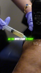39K views · 24 reactions | When excess fluid is present in the knee,...