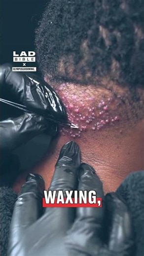 Removing Extreme Ingrowing Hairs 😳