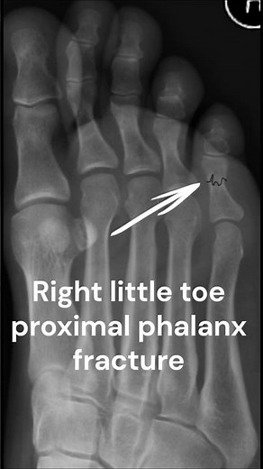 Right little toe proximal phalanx fracture