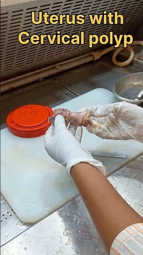 Uterus specimen with cervical polyp | #histopathology #cervicalpolyp #uterineprolapse #uterusremoval