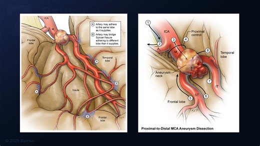 #394: Mini-Pterional Craniotomy for Clipping of a Middle Cerebral Artery Aneurysm - All Videos - Seven Series Collection