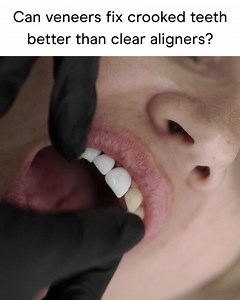 Straighter teeth for thousands less than braces. 🍉 Summer Sale: save up to $400 before this exclusive offer ends. Code: SUNSAVINGS. | Candid