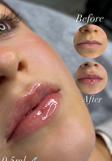 Transform Your Lips with 0.5 ml Lip Filler