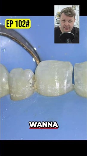 Precise Dental Decay Removal Protecting Adjacent Teeth