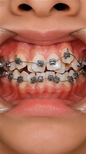 Braces challenge: Fix super crowded teeth #braces #dentalprosthesis #dentist #orthodontics #brackets