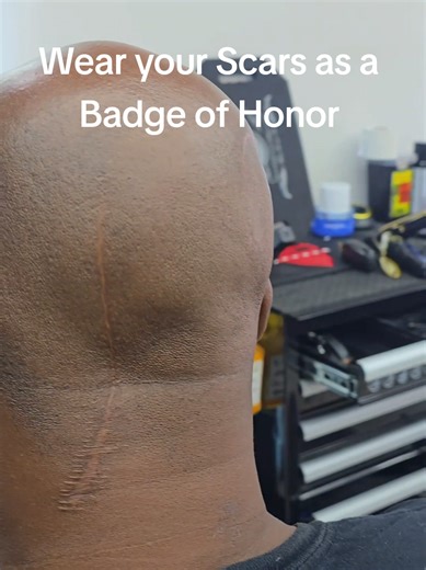 Making lemonade out of Lemons. I have been bald since the age of 25, then I had a craniotomy at 41. I was not able to hide my scars. My Mom made me acknowledge them and show them with pride. To me they are like tattoos, I have them but you get to see them. If you had surgery to augment your body, hopefully you can move past the shame and live your life. #craniotomy #stroke #avm #dtuhtl #liveyourlife