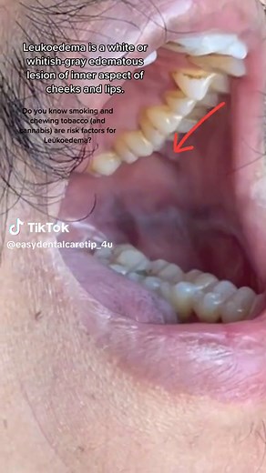 Understanding White Spots and Lesions in the Mouth