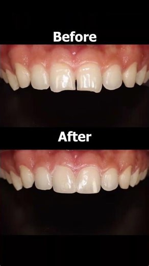 Closing gap and transforming smile with Bioclear build up | Dr Neha Agarwal