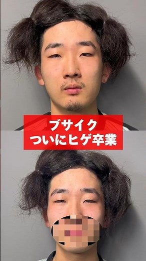 ブサイク、ついにヒゲ卒業します。 #オーガスと #脱毛 #pr
