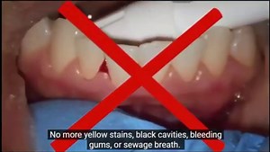 Dentitox Pro - I REVEALED THE TRUTH - Dentitox Pro Review - Dentitox Pro Supplement - video Dailymotion