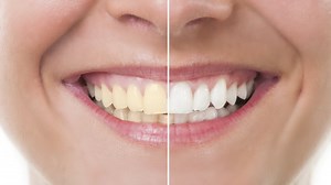 218K views · 2K reactions | A dentist reveals the most effective way to whiten your teeth. | Insider Tech | Facebook